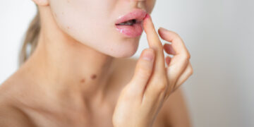 Visada netinkamiausiu metu – lūpų pūslelinė: kaip ją greičiau išgydyti?