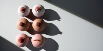 Krūtinės didinimo kainos Lietuvoje ir užsienyje: kur pigiau ir saugiau? Atsako chirurgas